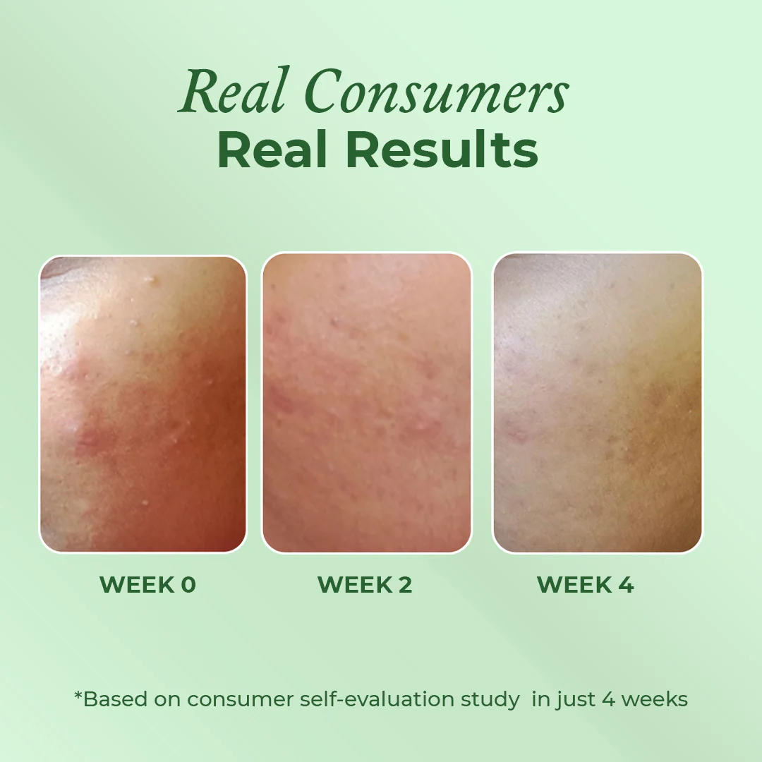 Acne Care & Healing Gel Moisturiser - Image 4