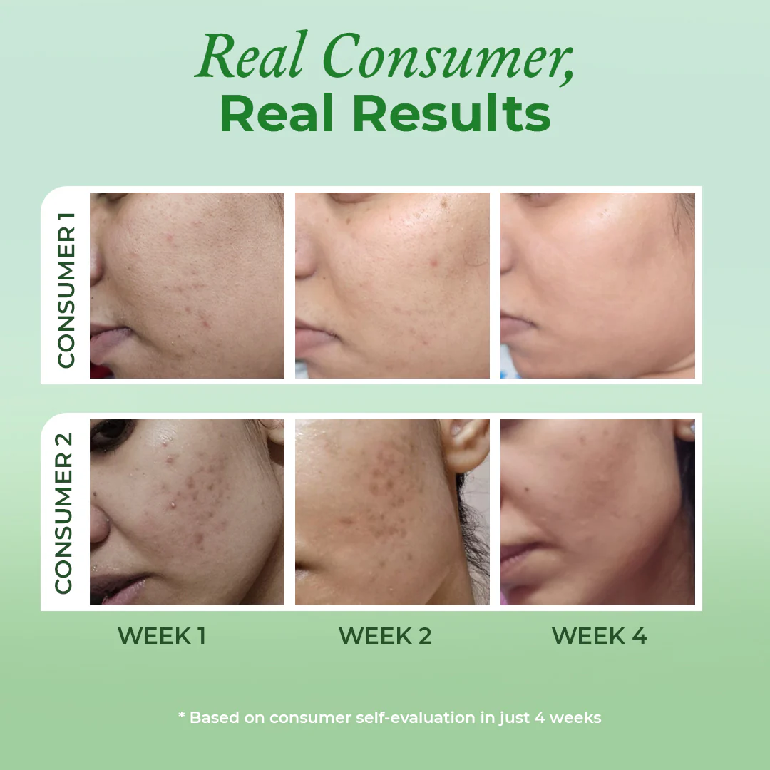 Acne & Oil Control Intense Serum with 2% Salicylic Acid - Image 4