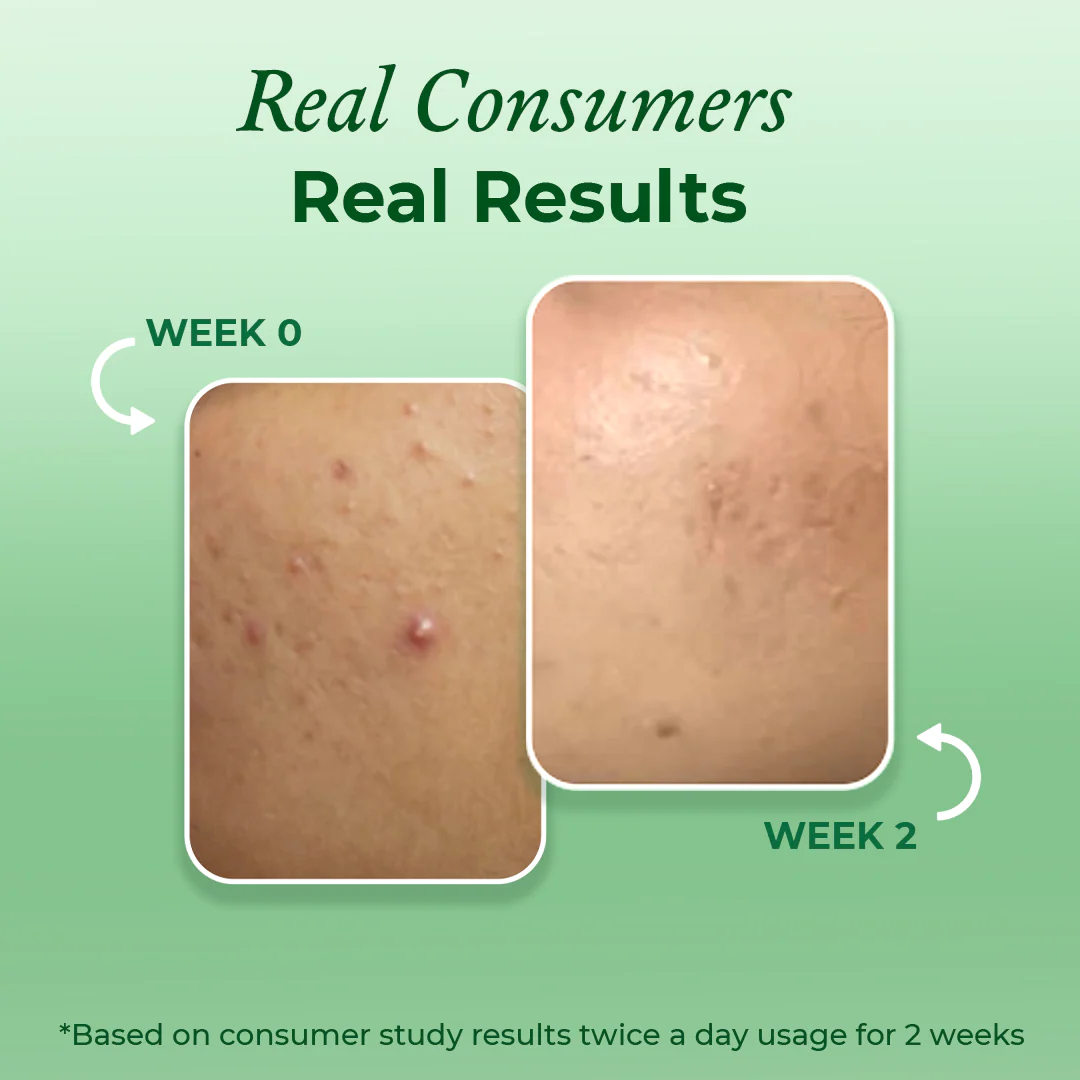Mini Clearing & Calming Acne Face Wash - Image 5