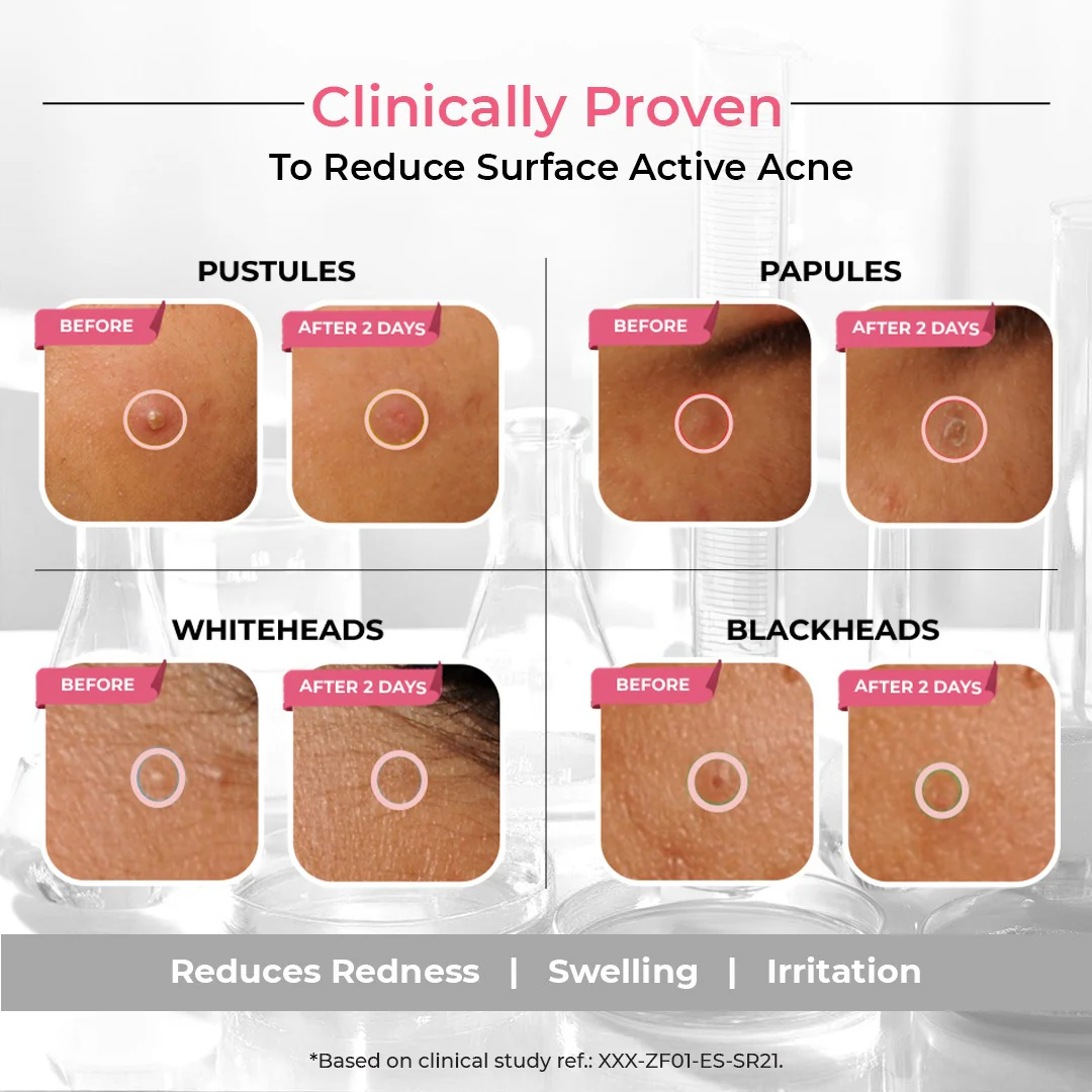 Overnight Acne Spot Corrector for Men - Image 5